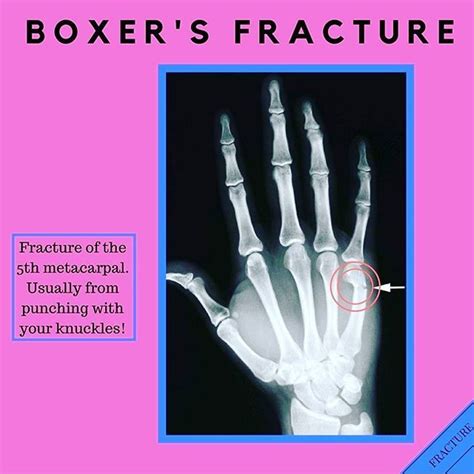Fracture Of At The Neck Of 5th Metacarpal This Is Known As A Boxers