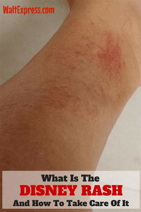 What Is The Disney Rash And How To Take Care Of It