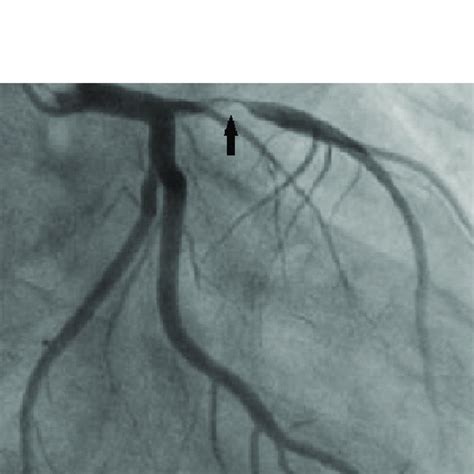 Coronary Angiogram Shows The Lad Lesion Arrow Lad Left Anterior