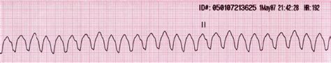Taquicardia Ventricular ECG