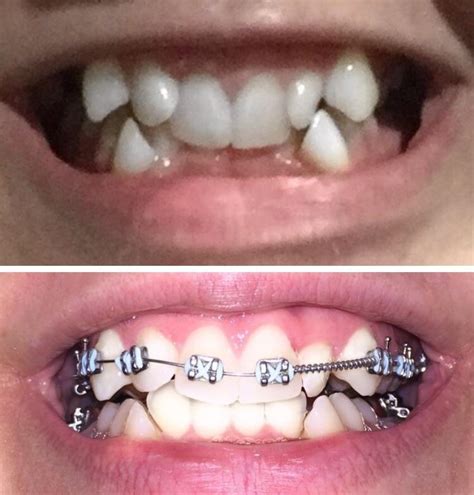Exactly Three Months Progress Bottom Braces Go On October 24 And My