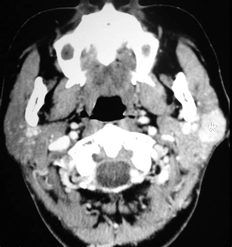 Ct Features Of Parotid Gland Oncocytomas A Study Of 10 Cases And