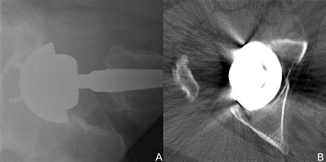 Cureus Surgical Management Of Iliopsoas Impingement With Combined
