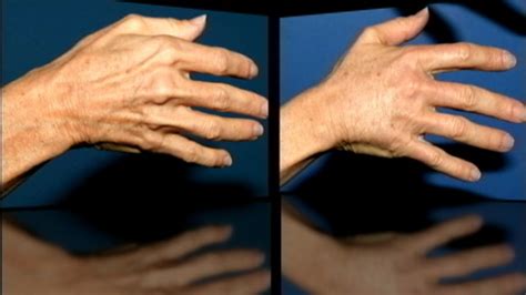 handlift comsemtic surgery for your hands do your hands give away your age video abc news