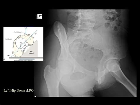 Ppt The Pelvic Girdle And Lower Limb Powerpoint Presentation Free