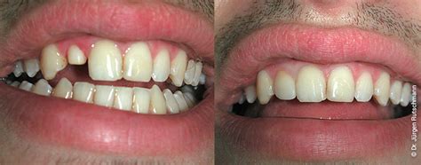 Hat eine karies einen zahn tief zerstört oder sind zähne unfallbedingt beschädigt, ist es häufig nicht mehr möglich, sie mit einer füllung, einem inlay, onlay oder overlay zu reparieren. Vollkeramik Zahn-Kronen, Material, Vorher Nachher, Zirkonzahn