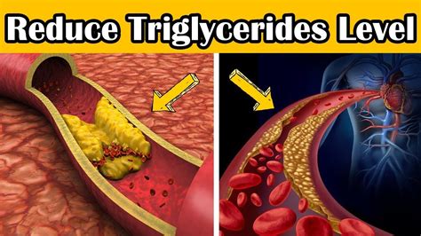 How To Reduce Triglycerides Level In Blood What Does High