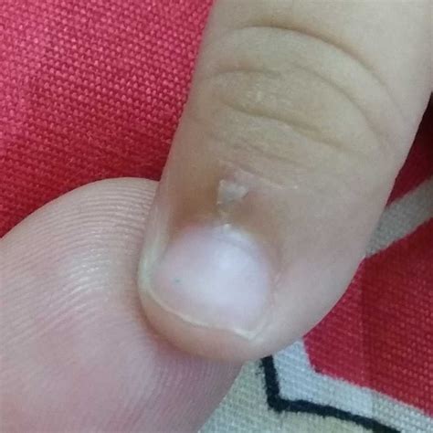 Why Does Peeling Of Fingers Skin Occur Near Nail In Babies Firstcry