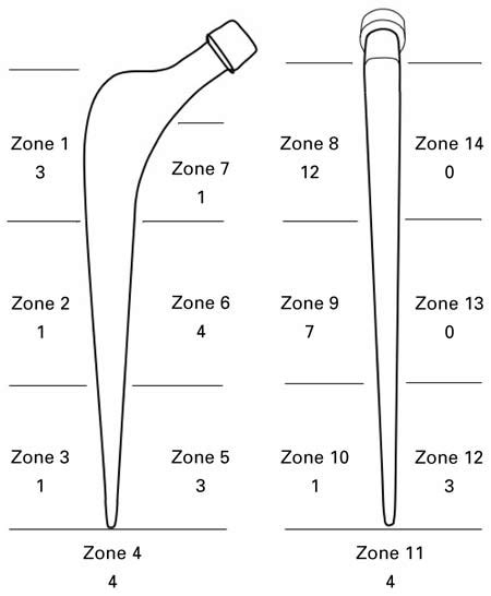Diagram Of The Defects Of The Cement Mantle Zones Of Gruen Et Al 13