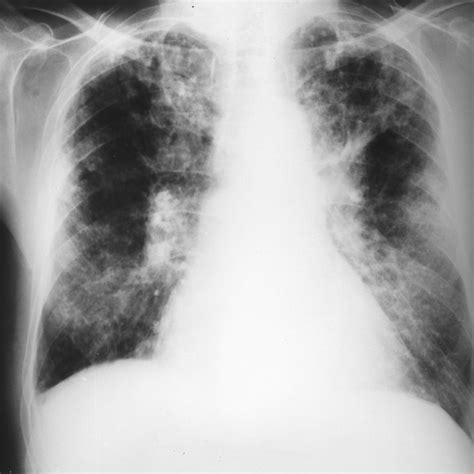 Semiinvasive Pulmonary Aspergillosis In Chronic Obstructive Pulmonary