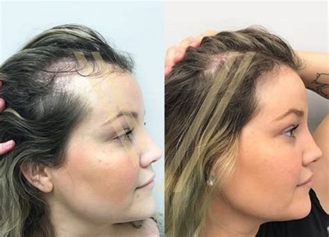 Details More Than 141 Hair Transplant For Big Forehead Super Hot Poppy