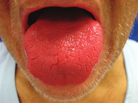 This Is What The Colour Of Your Tongue Says About Your Health • Page 2 Of 5