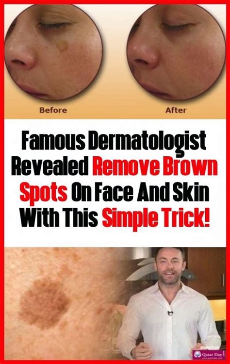 Famous Dermatologist Revealed Remove Brown Spots On Face And Skin With