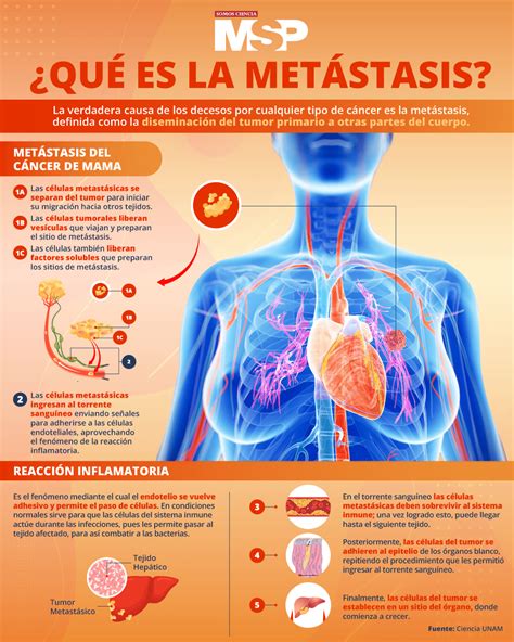 ¿qué Es La Metástasis Infografía