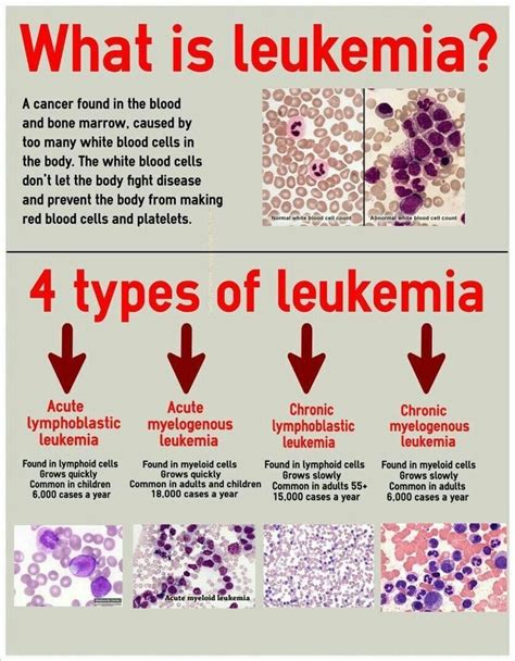 Funnydoc “4 Types Of Leukemia ” Medical Laboratory Science