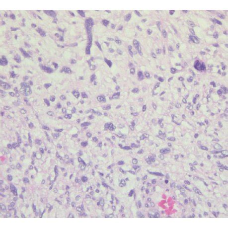 A And B Malignant Triton Tumor Mtt Cells Tumor Cellularity And