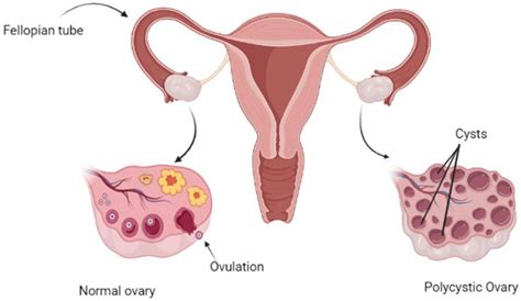 Symptoms Of Polycystic Ovary Syndrome Pcos You Should Never Ignore Huffington News