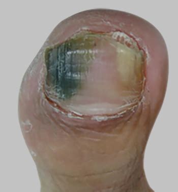Had tried the pills and toenail polish. Green fungal nail - Dubai Podiatry Centre