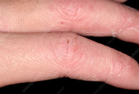 Eczema Stock Image C0370860 Science Photo Library