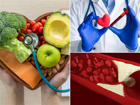 ¿qué Es La Hipercolesterolemia Causas Síntomas Prevención Y Dietas