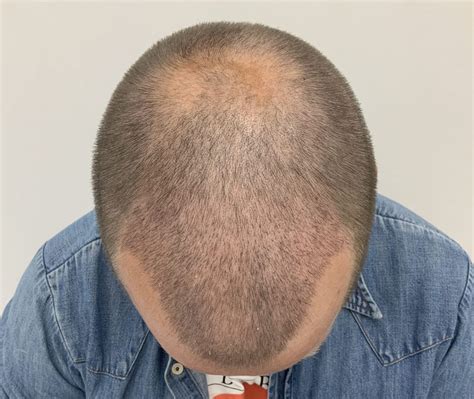 How Does The Hair Grow After A Hair Transplant Nordic Hair