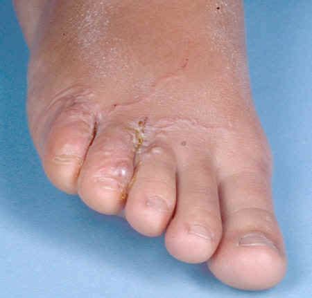 Skin Rashes On Feet