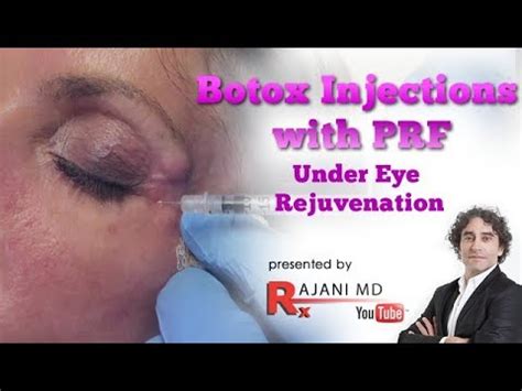 Botox Eye Injections With Prf Under Eye Bags Treatment Youtube