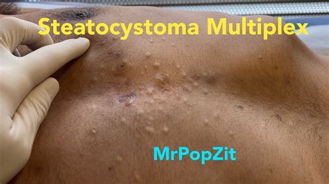Steatocystoma Multiplex Dozens Of Extractions On The Chest Chronic