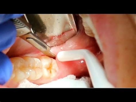 90 Second Non Invasive Wisdom Tooth Extraction Procedure YouTube