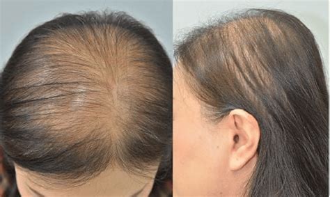 What Does 100 Strands Of Hair Loss Look Like