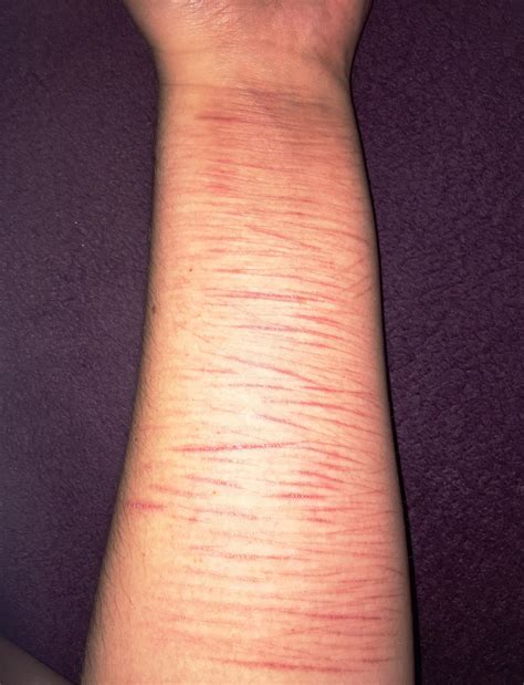 I didn't think i cut deep enough for it to scar, and since the cuts have been there for only two week, i don't. About two to three weeks of healing on the really red ones ...