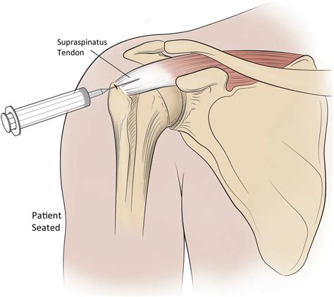 First Injection Was Made Into The Supraspinatus Tendon Insertion