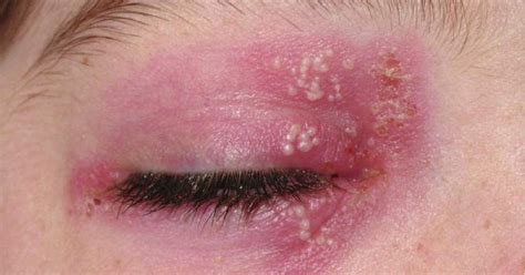 Diagnosis and treatment / aad. Study Medical Photos: Ocular Herpes Simplex.