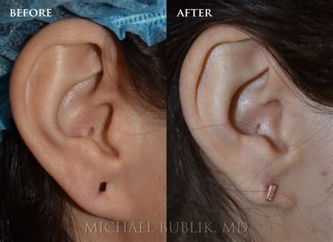 Ear Gauge Repair Earlobe Repair Harris Facial Plastic Surgery Utah