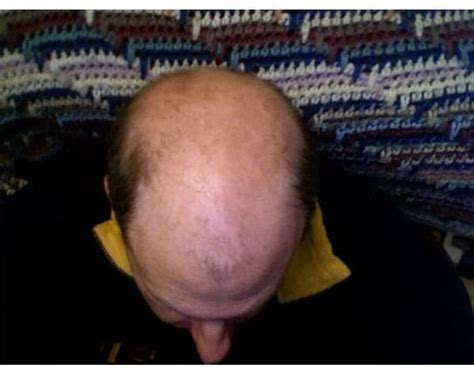 Possible Baldness Gene Discovered And How It Could Lead To New Baldness