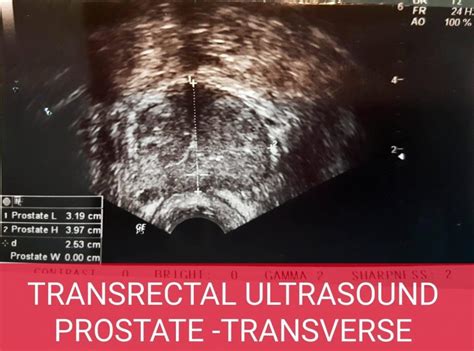 Transrectal Ultrasonography Of The Prostate Urology Malaysia