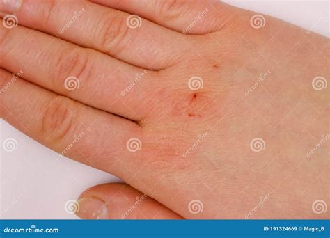 Cracked Dry Skin On Hands Under The Fingers Of A Young White Woman