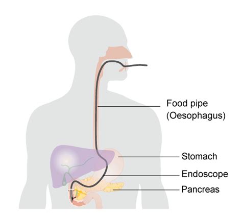 Ercp Endoscopic Retrograde Cholangio Pancreatogram Bridges Clinic