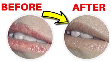 how to get rid of fordyce spots on lips naturally at home little white white lips