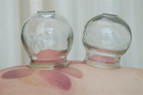 Cupping Pictures