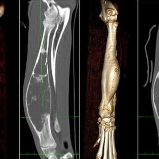 Both Threedimensional Bone Reconstruction And Multiplanar