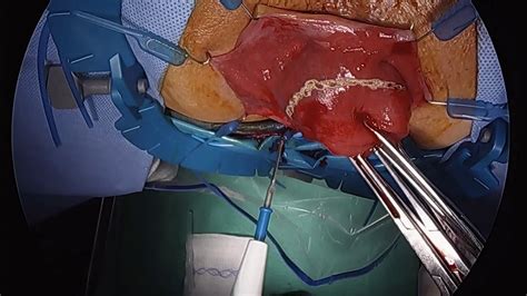 A New Approach For Rectal Prolapse Perineal Proctectomy