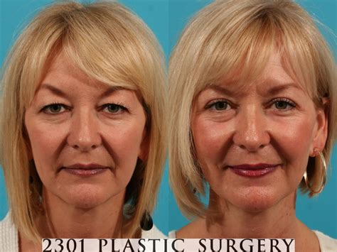 Eye Plastic Surgery Before And After Plastic Industry In The World