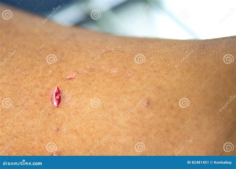 Dog Bite Wound Stock Image Image Of Hygiene Injury 82481451