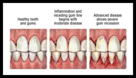Diagram Showing Healthy Teeth And Gums To Advanced Periodontal Disease