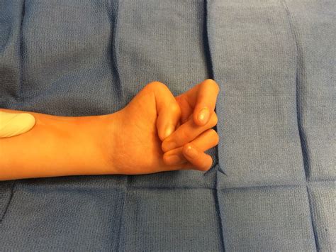 The Arthrogryposis Thumb Congenital Hand And Arm Differences
