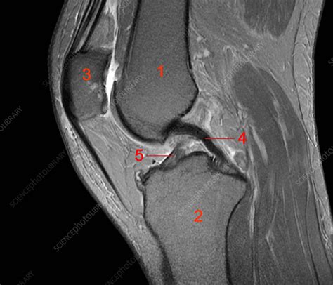 Normal Knee Mri Scan Stock Image C0261160 Science Photo Library