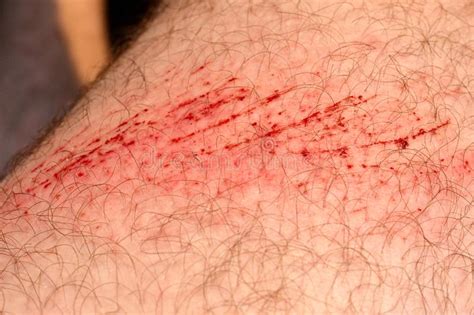 Scratch Skin Wound Or Cut On The Skin Red Blood Hairy Part Of A Man
