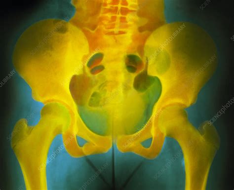 Normal Pelvis X Ray Stock Image P1160219 Science Photo Library