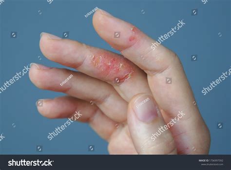 Atopic Hand Dermatitis Eczema On Fingers Stock Photo 1736997392